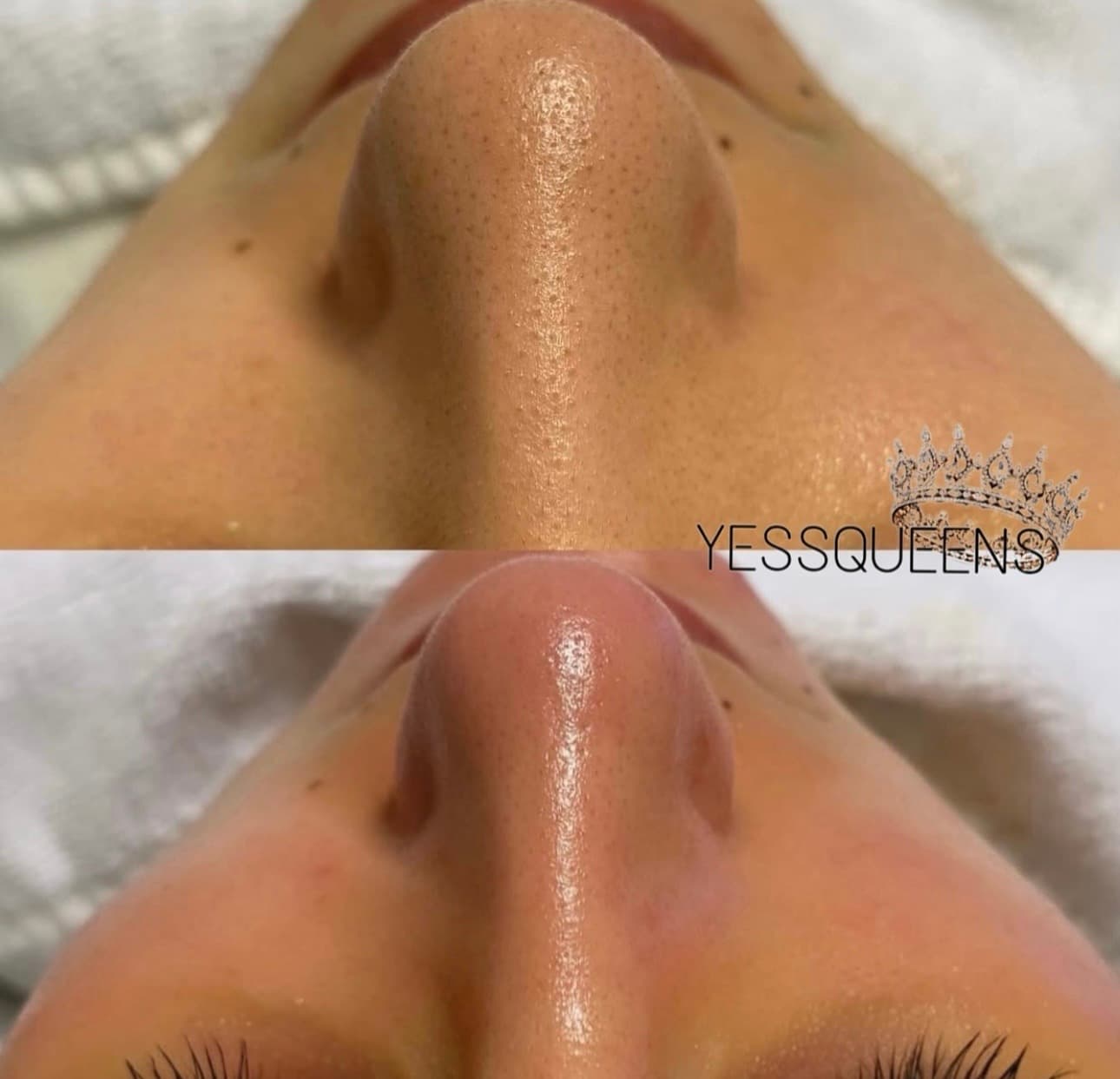 Hydradermabrasion