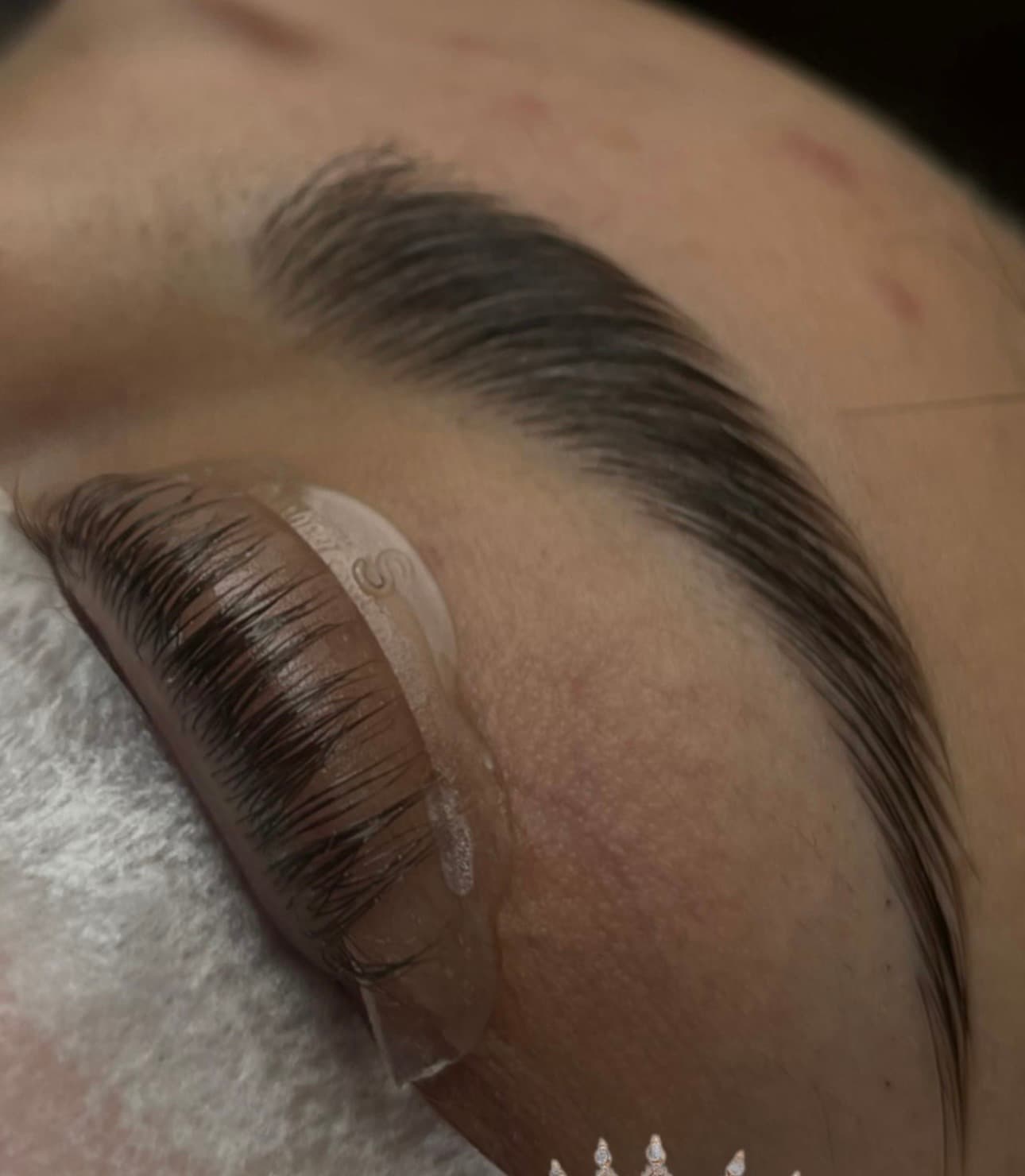 Brow Lift