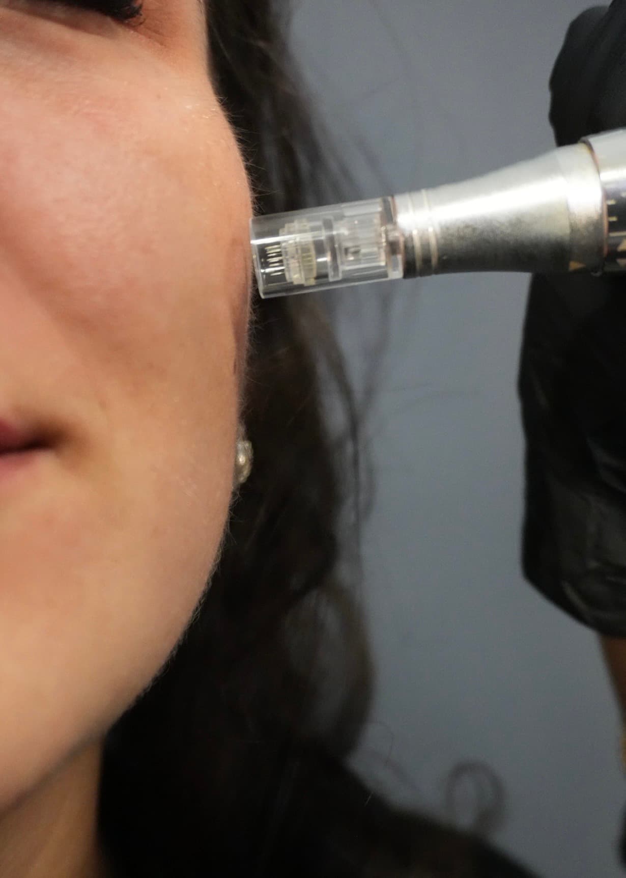 Microneedling Lips