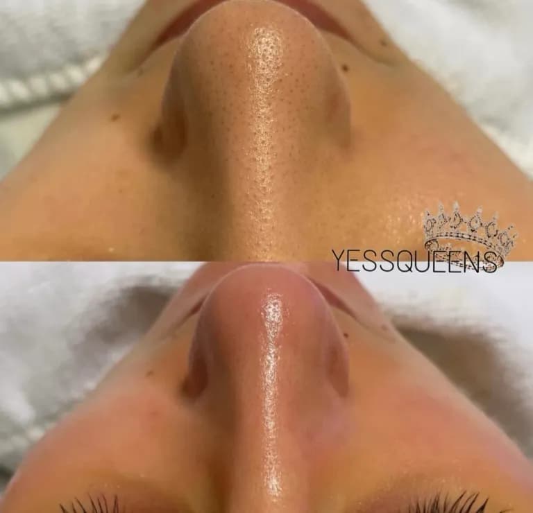 Hydradermabrasion